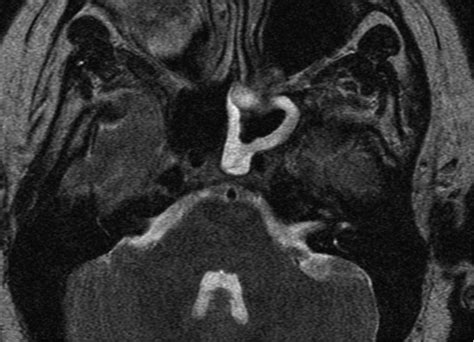 Primary And Referred Otalgia Pathways Of The Facial Nerve Vii