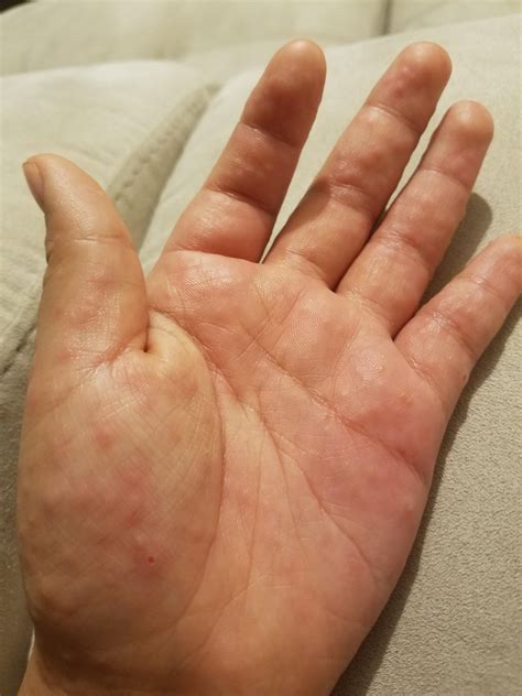 Stress Related Eczema On Hands How To Treat Eczema On Hands Causes