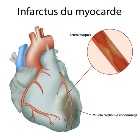 Les Douleurs Au Cœur Quelles En Sont Les Causes Information