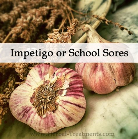 Herbal Medicine For Impetigo Or School Sores Avnayt And Walthams