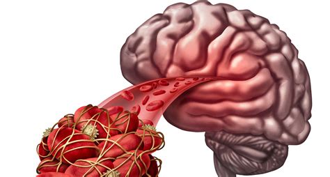 Cerebral Artery Thrombosis Treatment In Florida By Neurosurgeon