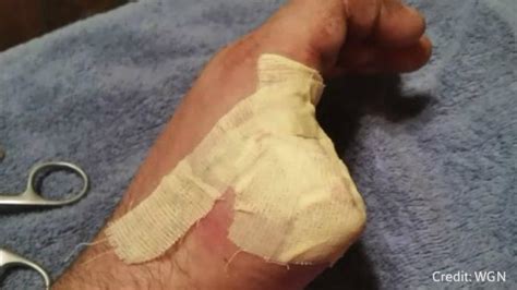 Man Cuts Off Thumb By Accident Has It Replaced With His Own Big Toe