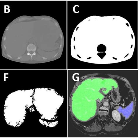 Four Phases Of Ct Scanning A Non Contrast Phase B Arterial Phase