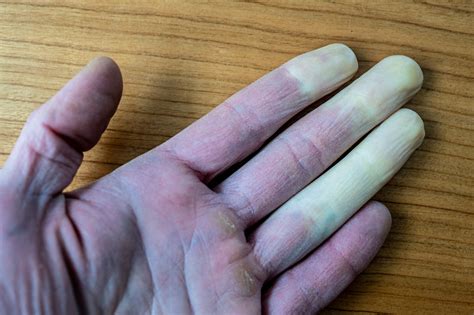 Raynauds Syndrome The Cold Truth Heales Clinics