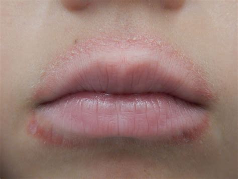 Causes And Treatments For A Rash Around The Mouth With Pictures