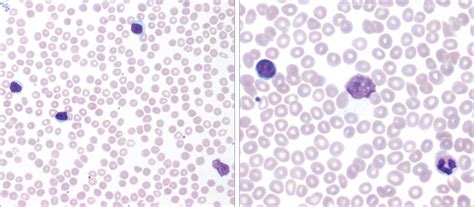 Weakness Fatigue And An Abnormal White Blood Cell Count Hematology