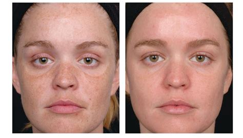 Tretinoin Before And After Photos What You Need To Know