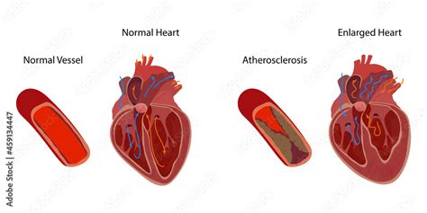 Normal And Enlarged Heart Cardiomegaly Atherosclerosis Direction Of