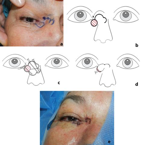 The Transnasal Bilobed Flap For Medial Canthal Reconstruction
