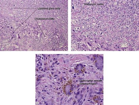 Fibrous Tumors Plastic Surgery Key