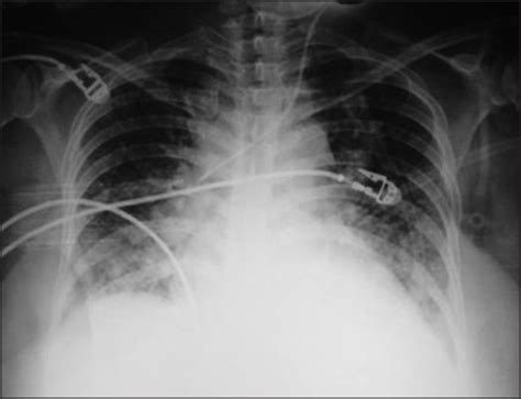 Chest X Ray Showing Cardiomegaly And Pulmonary Congestion