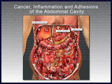 Cancer Inflammation And Adhesions Of The Abdominal Cavity