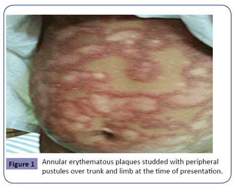 Exfoliative Dermatitis Secondary To Acute Generalized Pustular