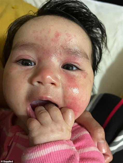 Eczema Relief Baby Suffers Severe Scalp And Face Eczema Until Using