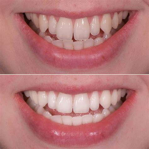 Before And After Teeth Filing