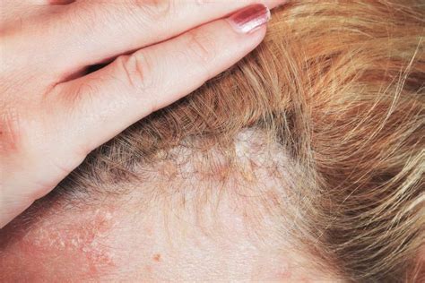 Psoriasis Hair Loss What Stimulates Regrowth