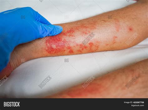 Eczema Skin Disease On Image And Photo Free Trial Bigstock