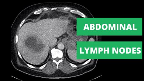 Abdominal Ct Lymph Node Stations How To Read A Ct Youtube