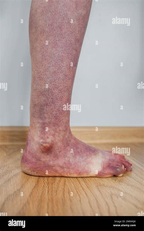 Leg Of Person With Orthostatic Intolerance Syndrome With Purple