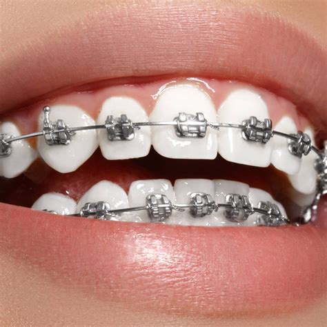 Conventional Metal Fixed Appliances Maraqa Orthodontics