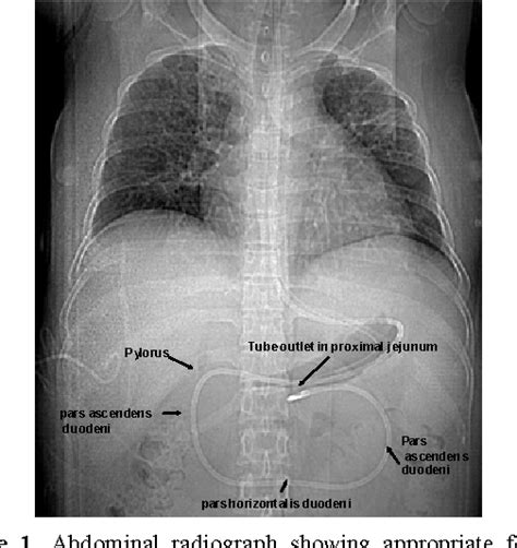 Figure 1 From Early Jejunal Feeding By Bedside Placement Of A Nasointestinal Tube Significantly