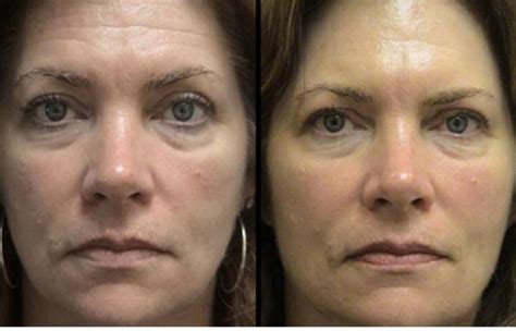 Red Light Therapy For Face Best Devices And Beforeafter Results