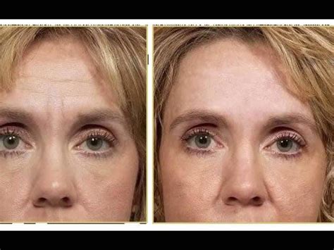 Frownies Wrinkles Removal Before And After Results Removeskinwrinkles