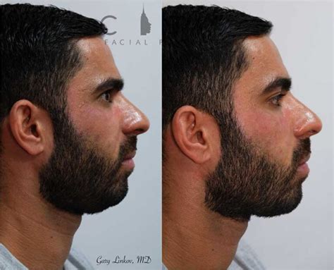 Nyc Cheek Filler Before And After Pictures New York Ues