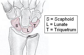 To determine the feasibility and interest of an early rehabilitation protocol with no initial immobilisation after proximal row carpectomy. Kienbock's Disease Treatment | Healthhype.com