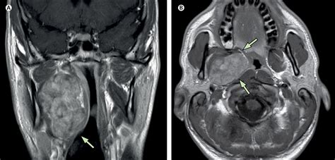 Large Parapharyngeal Mass A Challenging Differential Diagnosis The