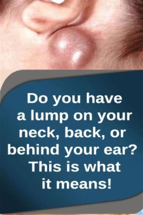 Do You Will Have A Lump In Your Neck Back Or Behind Your Ear That Is