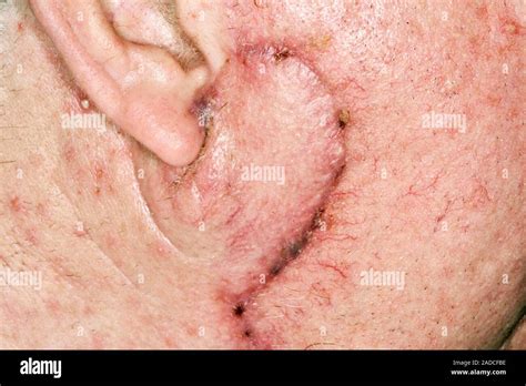Squamous Cell Carcinoma Skin Cancer Excision Site Close Up Of The