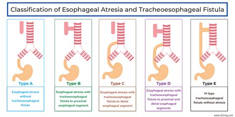 Tracheoesophageal Fistula Classification