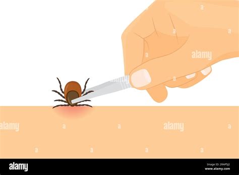 Removing Tick Using Tweezers Risk Of Infection Of Lyme And Tick Borne