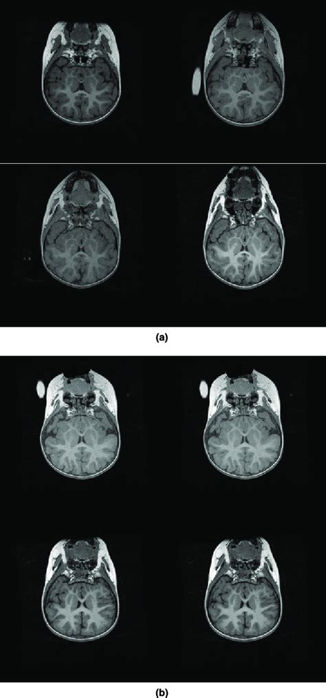 The Examples Of Brain Mri Are Shown For Autistic Group And Control