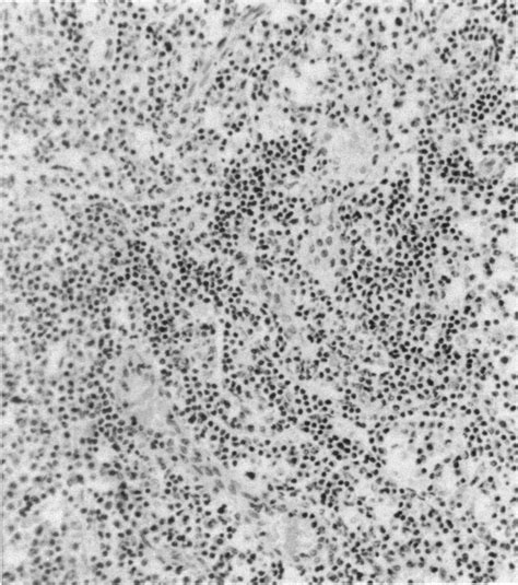 Reactive Lymphoid Tissue Hyperplasia With Effacement Of The Normal