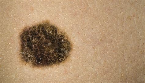 Structureless Light Brown Areas Important When Evaluating Melanoma In