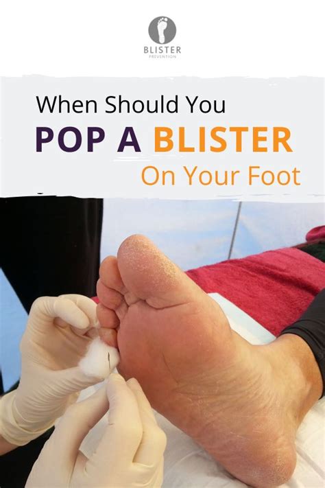 When Should You Pop A Blister On Your Foot Blister Treatment