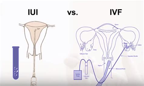 Iui And Ivf