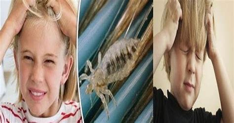 Head Lice Symptoms And Causes Home Remedies For Treating Head Lice
