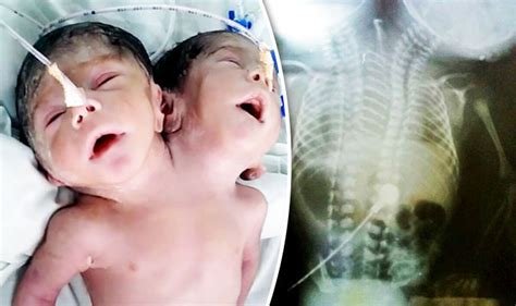 Two Headed Baby Born With Rare Condition In India World News
