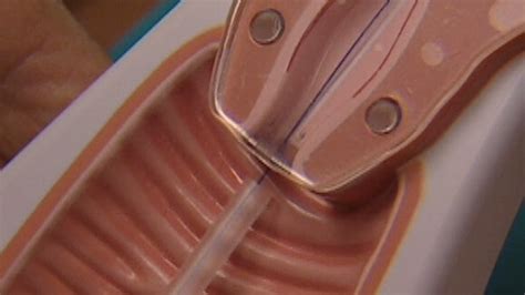 Copper iud is the iuds wrapped with copper wire. IUDs, implants are best birth control methods for teens ...