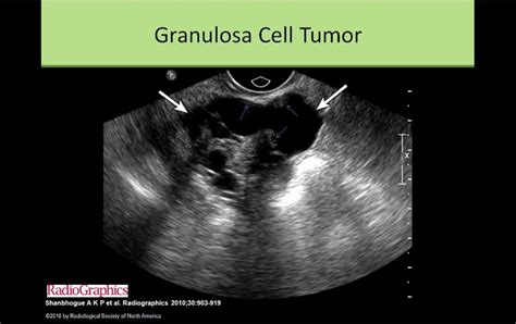 Granulosa Cell Tumor Tumor Gynecology Pathology