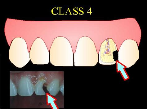 Class 3 And 4 Cavity