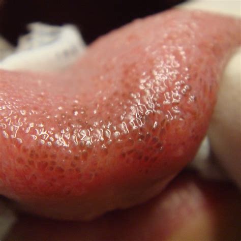 Fissured Tongue Fissured Tongue Characterized By Grooves That Vary In Download Scientific