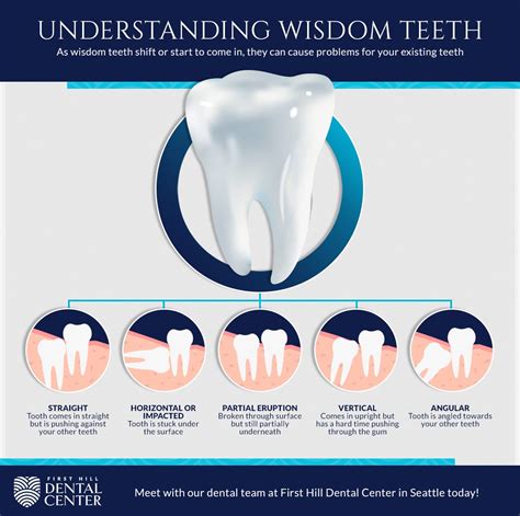 Dentist Seattle How To Know Its Time To Remove Your Wisdom Teeth