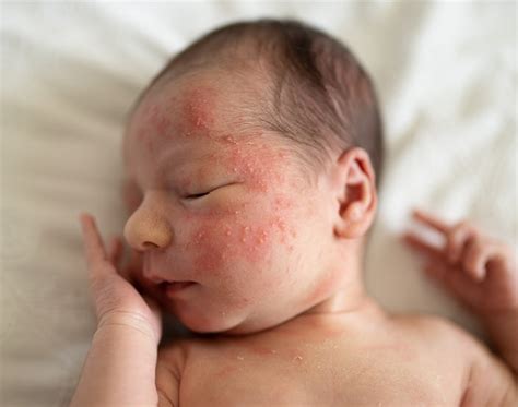 How To Get Rid Of Baby Acne