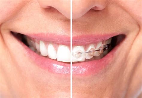 How Long Do You Have To Wear Braces Calismile Orthodontics