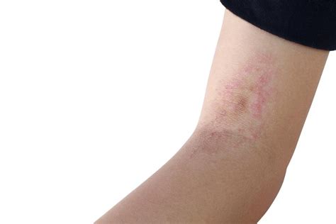 7 Natural And Effective Ways To Get Rid Of Ringworm Infection