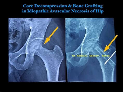 Avascular Necrosis Avn Treatment Management Dr Ashwini Gaurav